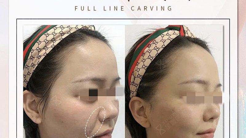 肉毒素VS玻尿酸：揭秘两种美容注射的奥秘
