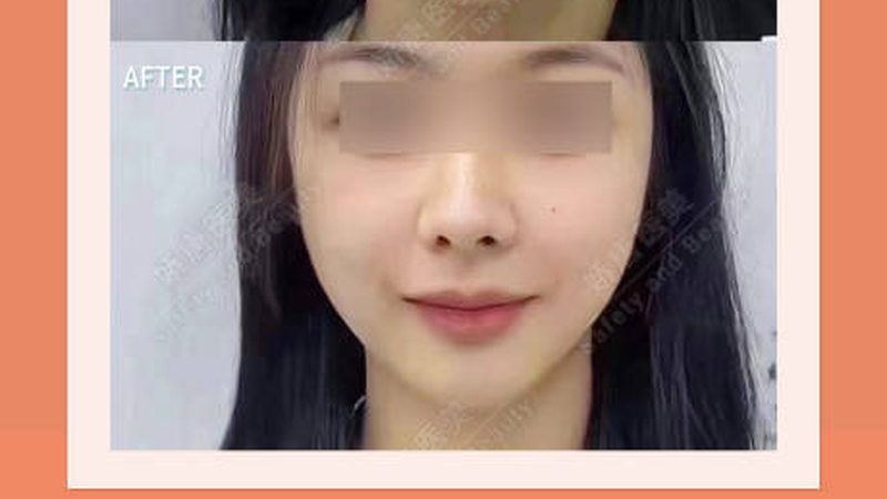 男士埋线提升：线材吸收时间揭秘**