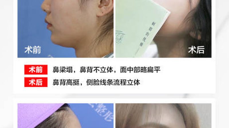 光子嫩肤后洗脸的最佳时机揭秘