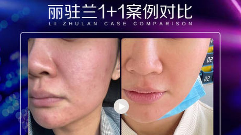 自然隆鼻与韩式隆鼻：维持时间之谜，揭秘差异与选择