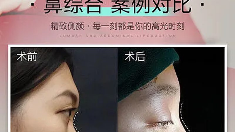 新手医美咨询师必备：医美术语解析**